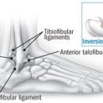 Diagram of ankle ligaments showing anterior talofibular ligament, calcaneofibular ligament, and posterior talofibular ligament