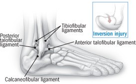 Diagram of ankle ligaments showing anterior talofibular ligament, calcaneofibular ligament, and posterior talofibular ligament