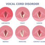 Artist's rendering illustrating common causes of voice problems, including viral infections, vocal overuse, vocal fold damage, nodules, and polyps.