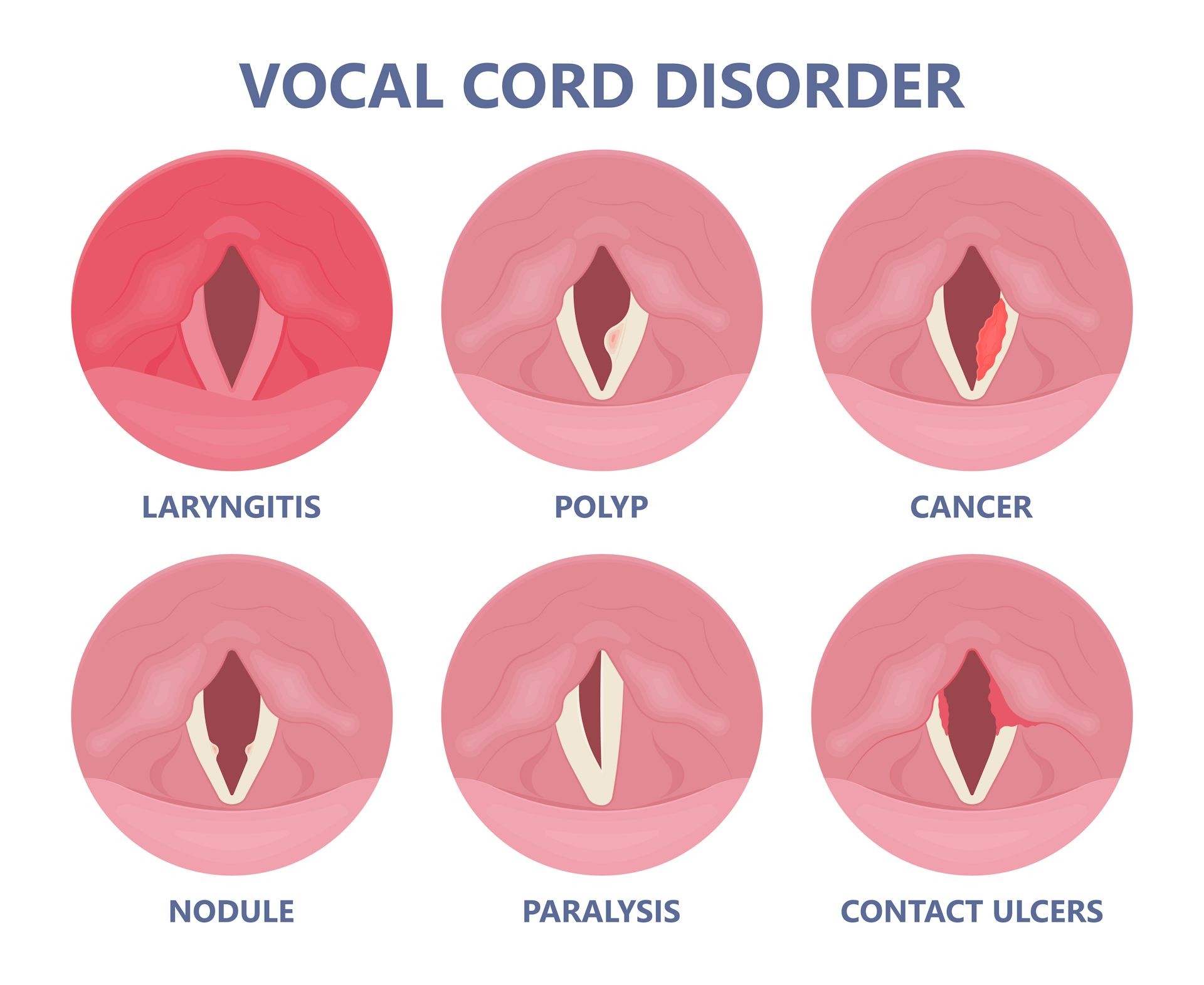 Artist's rendering illustrating common causes of voice problems, including viral infections, vocal overuse, vocal fold damage, nodules, and polyps.