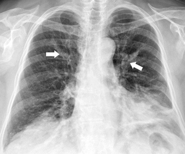 Finger-in-glove sign on chest radiograph