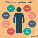 Places where heats rash can occur: Back, Armpits, Waist, Elbow creases, Back of your knees, Chest, Groin and Under your breasts