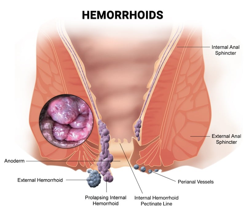 Diagram illustrating Hemorrhoids, a common anorectal condition, for educational purposes.