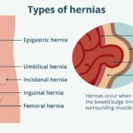 Illustration depicting hernia locations and the internal view of a hernia with bowel protrusion.