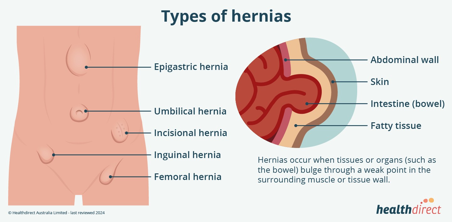 Illustration depicting hernia locations and the internal view of a hernia with bowel protrusion.