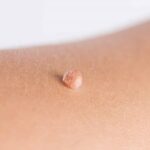 Understanding skin tag removal methods and causes