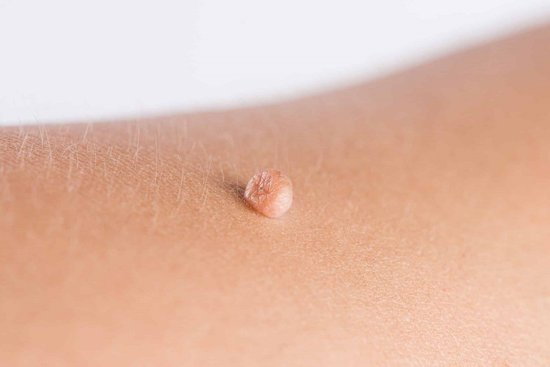 Understanding skin tag removal methods and causes