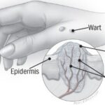 Skin wart close-up, highlighting the rough texture and dark capillaries within a typical wart
