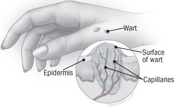 Skin wart close-up, highlighting the rough texture and dark capillaries within a typical wart