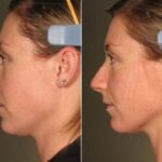 Ultherapy Before and After Results