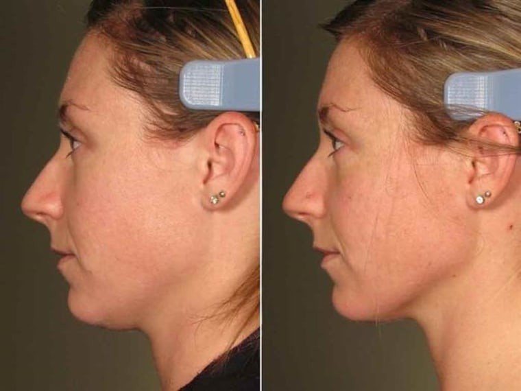 Ultherapy Before and After Results