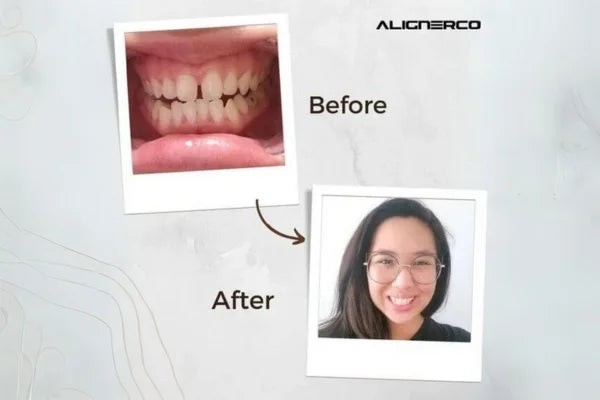 A comparison of a patient’s teeth before and after using ALIGNERCO clear aligners