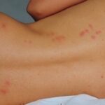Bedbug bites