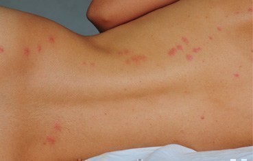 Bedbug bites
