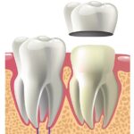 Dental Crown