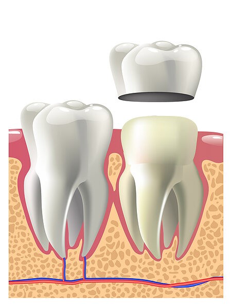 Dental Crown
