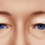 Eyelid surgery cost elements - Anesthesia fee, facility fee, pre- and post-operative care fees