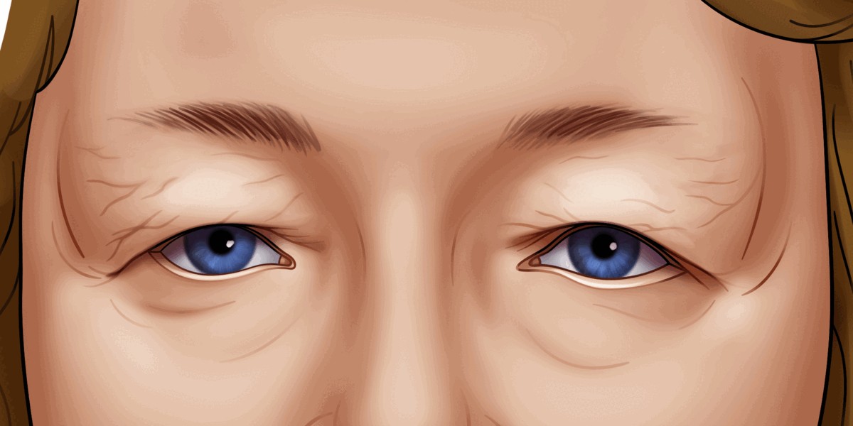 Eyelid surgery cost elements - Anesthesia fee, facility fee, pre- and post-operative care fees