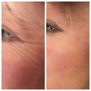 Botox injection points