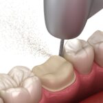 dental crown prep