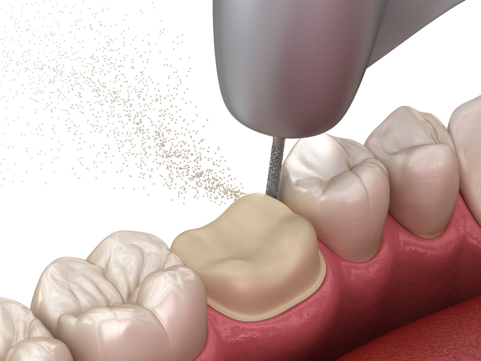 dental crown prep