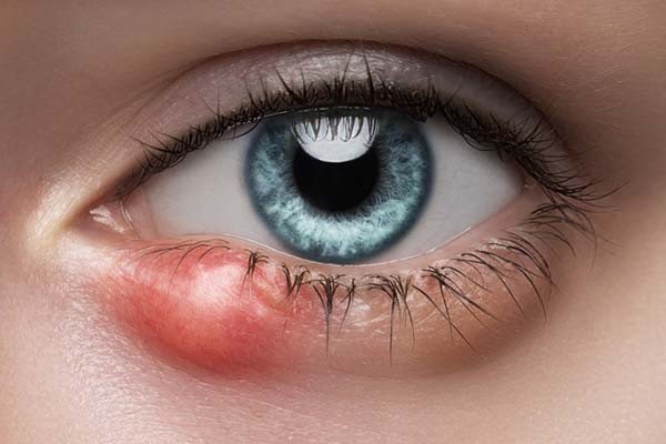warm compress applied to eye