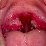 Tonsil Stones Formation