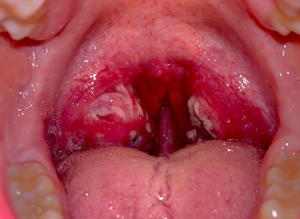 Tonsil Stones Formation