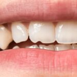 Close-up of a chipped tooth requiring immediate dental care