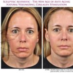 Sculptra before and after results showcasing facial rejuvenation