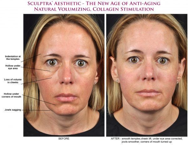 Sculptra before and after results showcasing facial rejuvenation