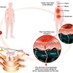 Shingles Home Remedies