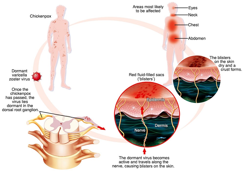 Shingles Home Remedies