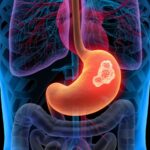 Toby Keith's public announcement of his stomach cancer diagnosis, raising awareness about the disease
