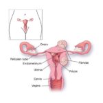 The female reproductive tract, showing uterine polyps and fibroids