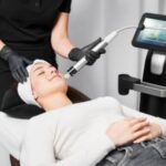Morpheus8 treatment for facial rejuvenation